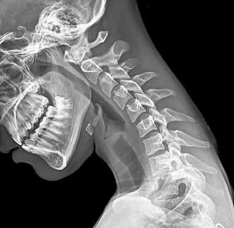 X-ray showing severe neck deformation from poor posture